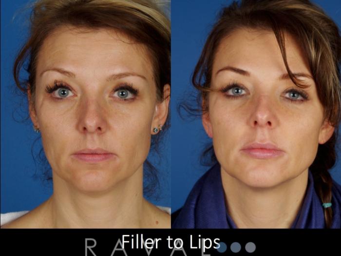 Before & After Botox & Dermal Fillers Case 1130 View 1 View in Denver, CO