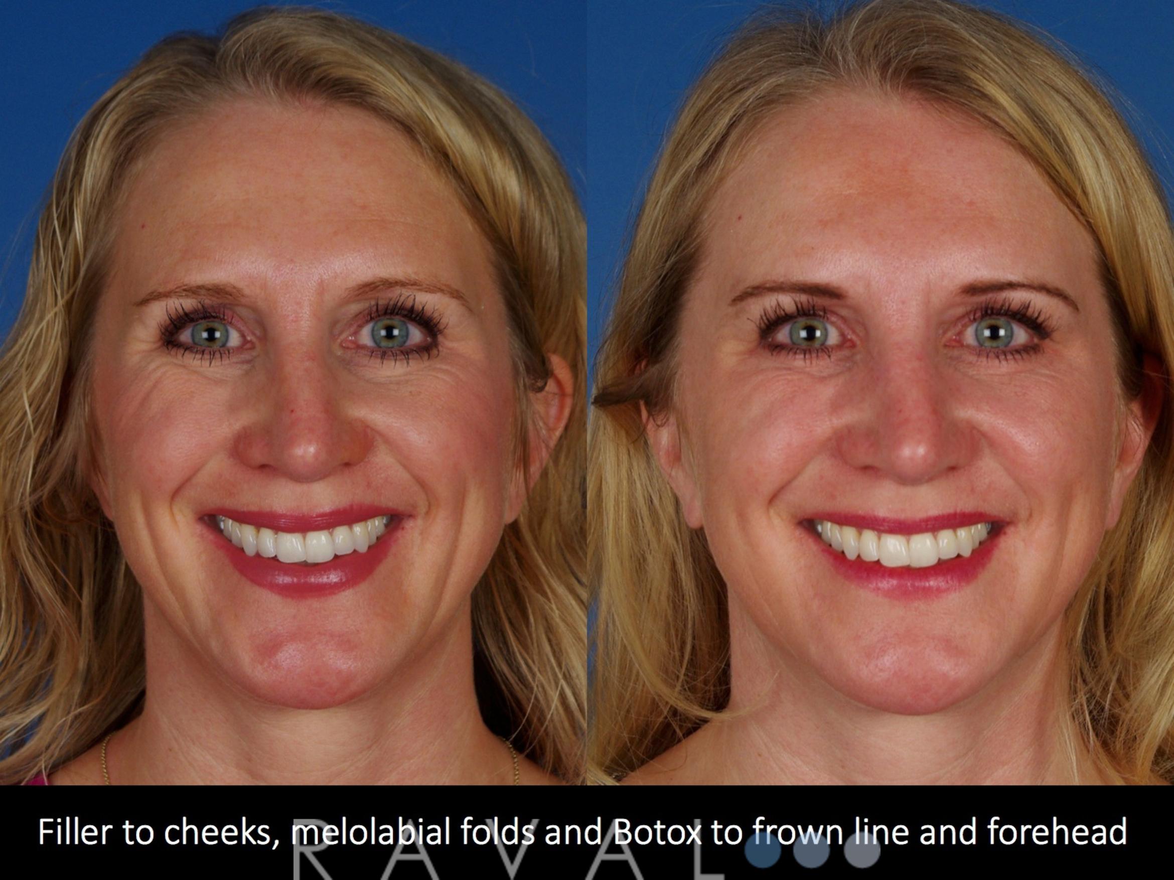 Before & After Botox & Dermal Fillers Case 1131 View 1 View in Denver, CO