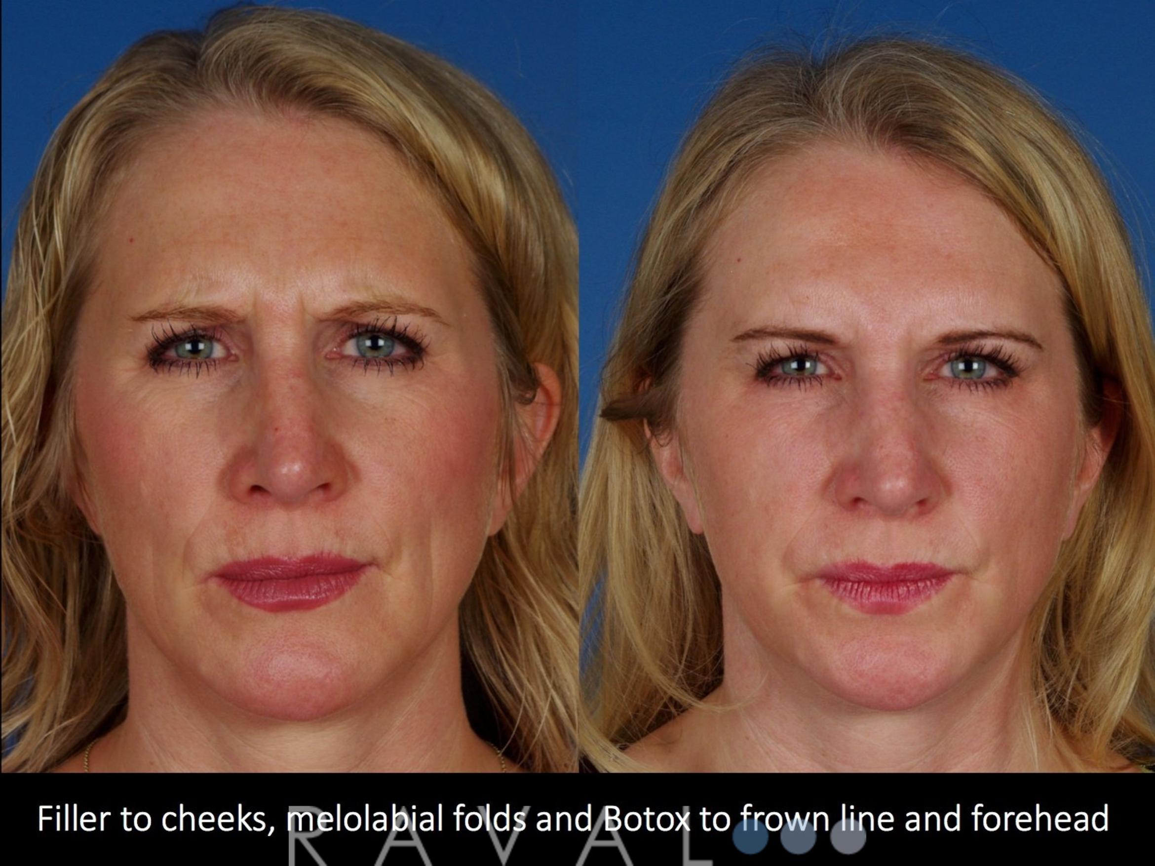 Before & After Botox & Dermal Fillers Case 1131 View 2 View in Denver, CO