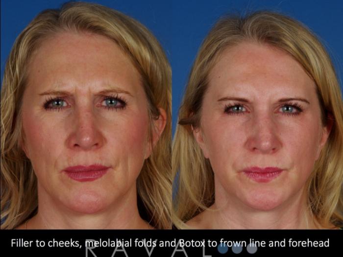 Before & After Botox & Dermal Fillers Case 1131 View 2 View in Denver, CO