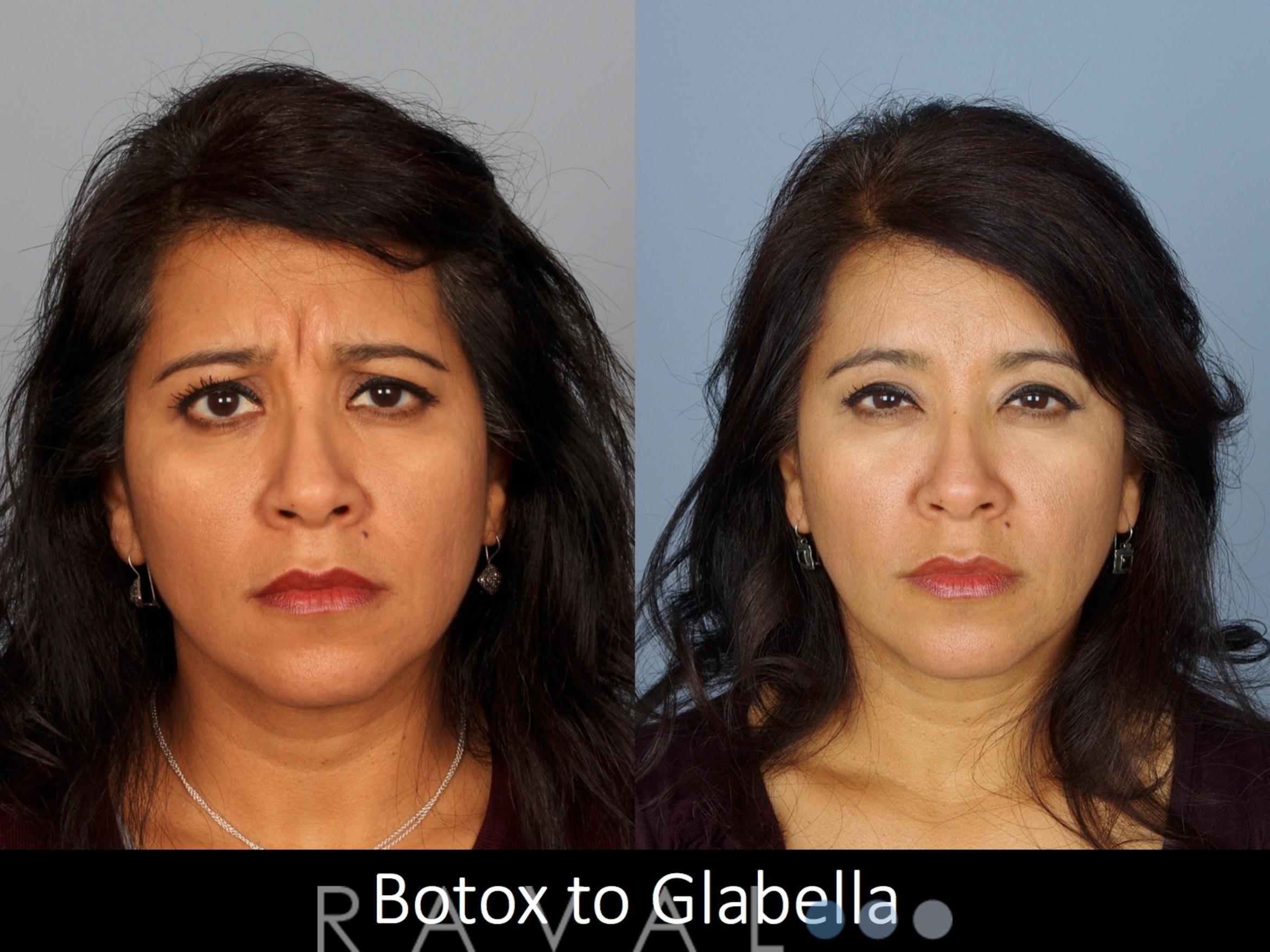 Before & After Botox & Dermal Fillers Case 1132 View 1 View in Denver, CO