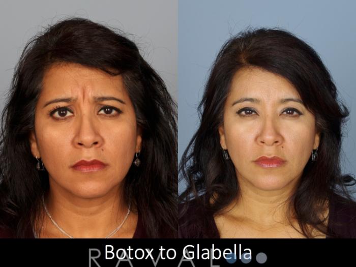 Before & After Botox & Dermal Fillers Case 1132 View 1 View in Denver, CO