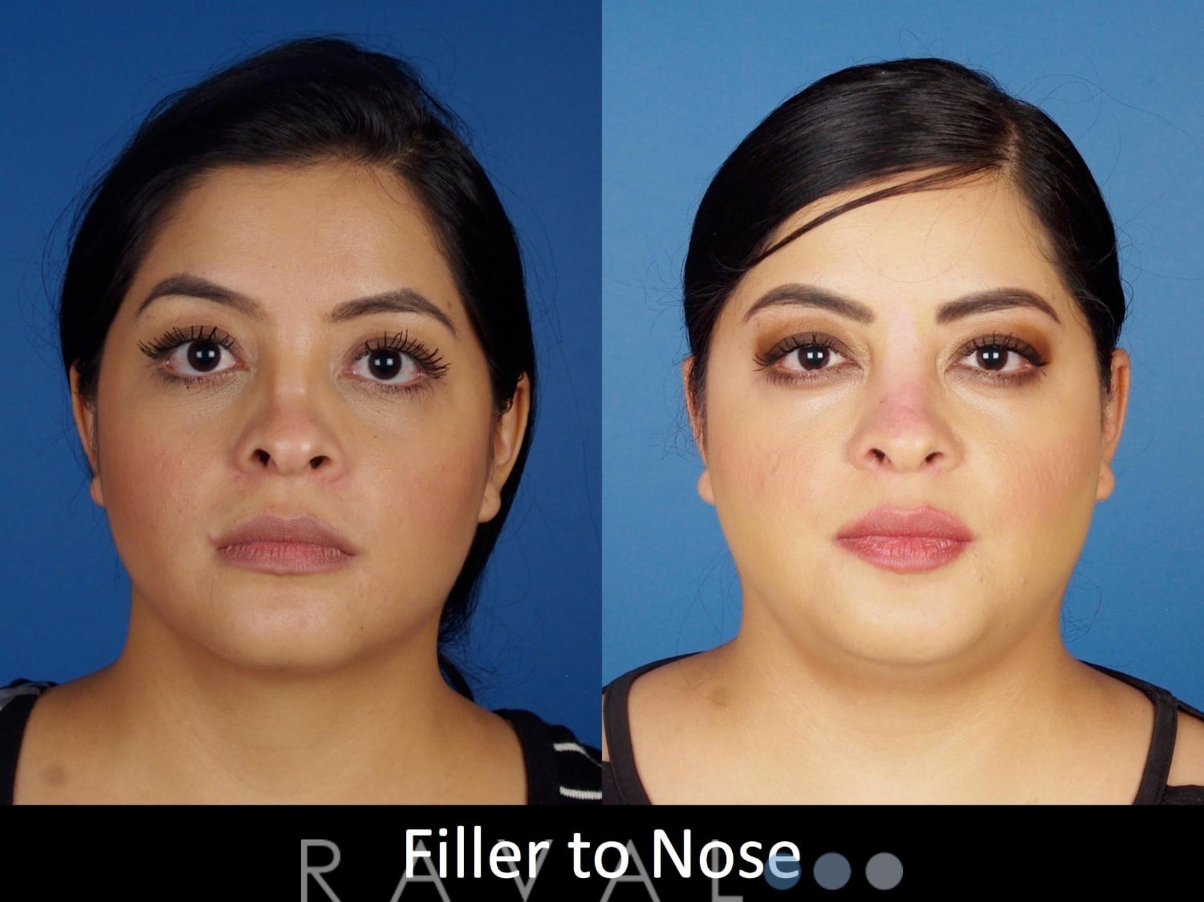 Before & After Botox & Dermal Fillers Case 1134 View 1 View in Denver, CO