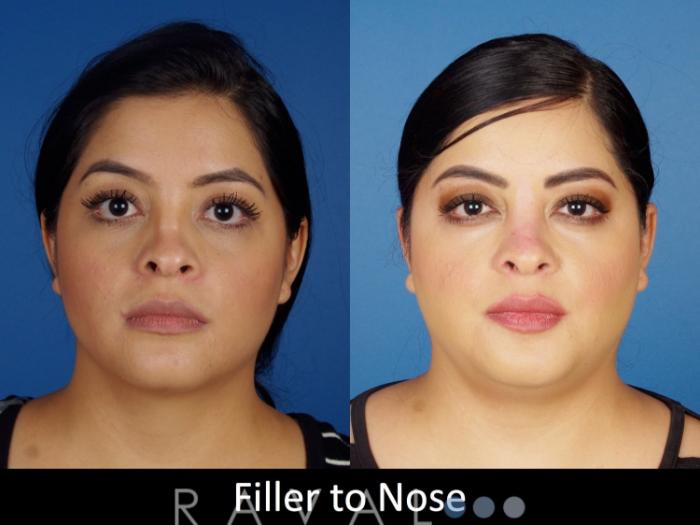 Before & After Botox & Dermal Fillers Case 1134 View 1 View in Denver, CO