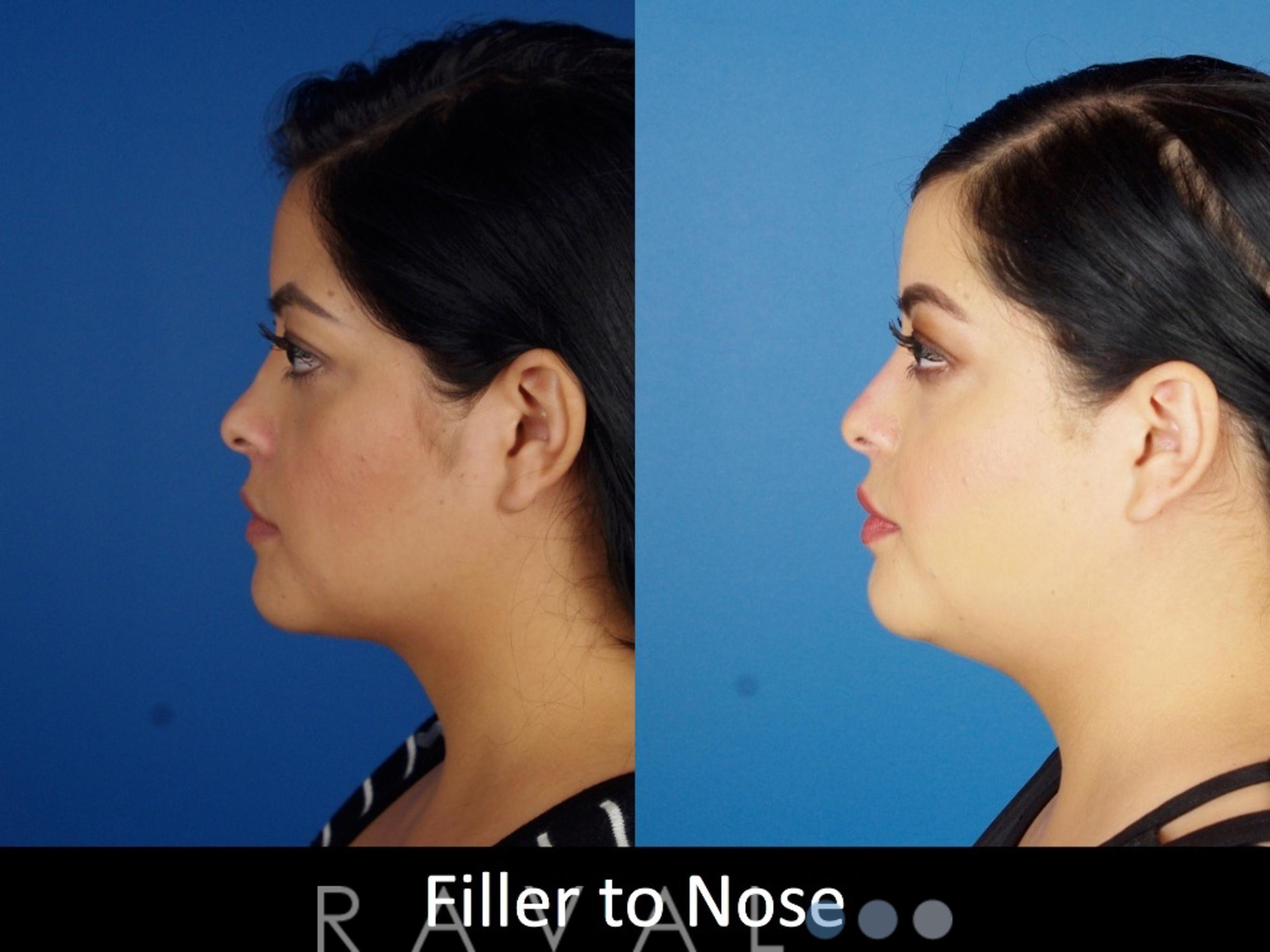 Before & After Botox & Dermal Fillers Case 1134 View 2 View in Denver, CO