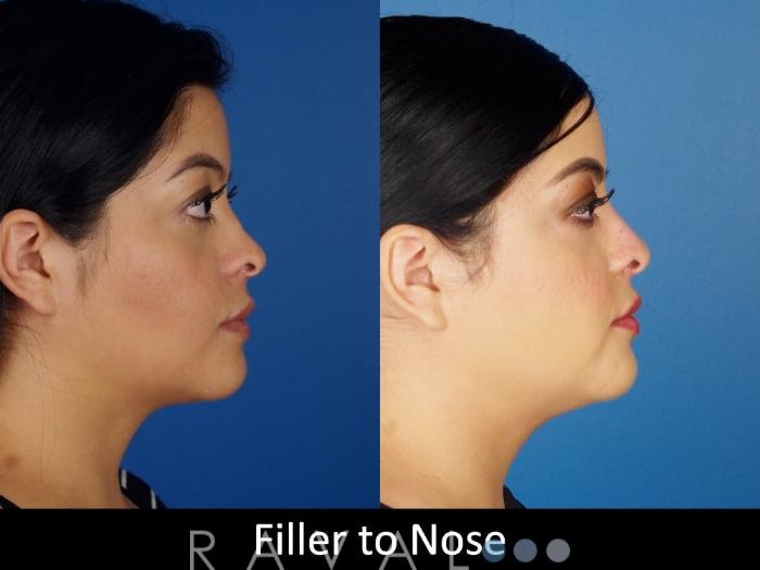Before & After Botox & Dermal Fillers Case 1134 View 3 View in Denver, CO
