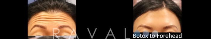 Before & After Botox & Dermal Fillers Case 1135 View 1 View in Denver, CO
