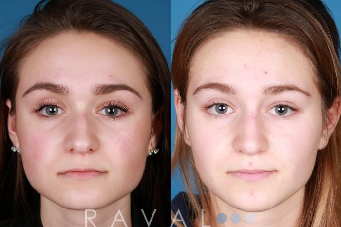 Before & After Botox & Dermal Fillers Case 1136 View 1 View in Denver, CO