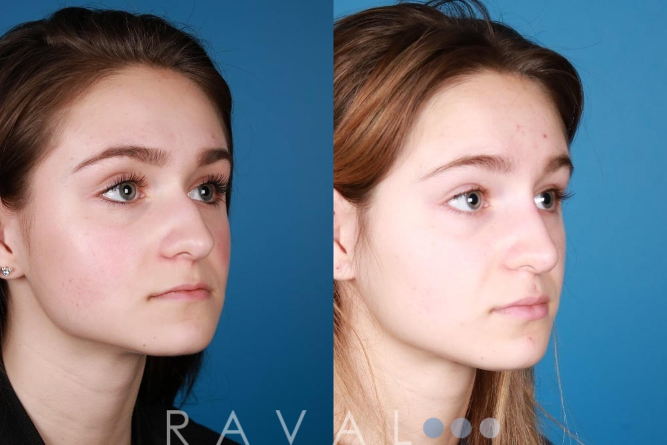 Before & After Botox & Dermal Fillers Case 1136 View 2 View in Denver, CO
