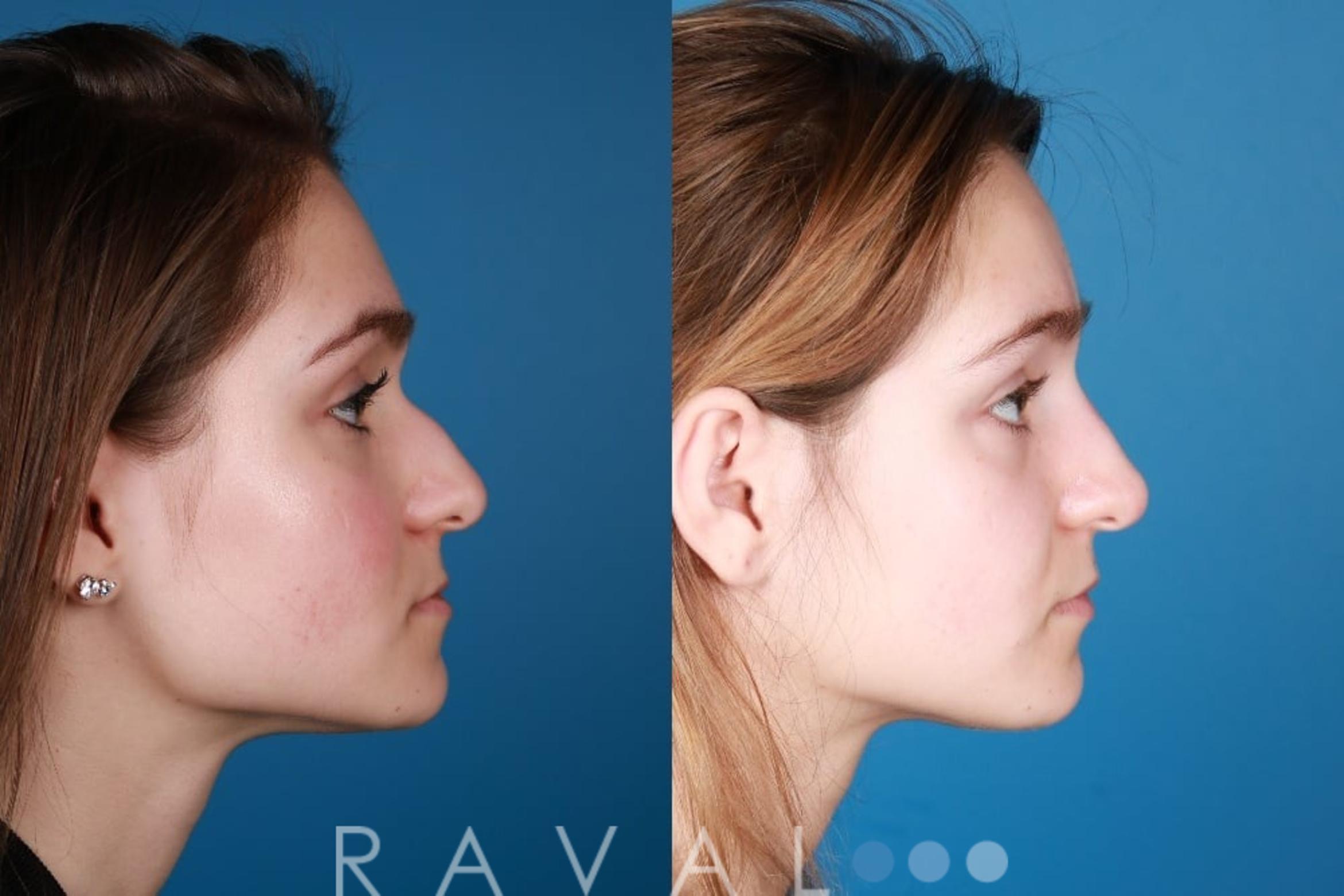 Before & After Botox & Dermal Fillers Case 1136 View 3 View in Denver, CO