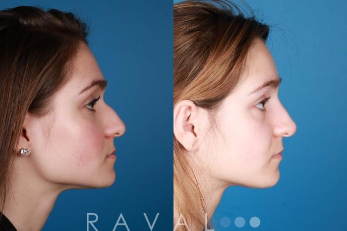 Before & After Botox & Dermal Fillers Case 1136 View 3 View in Denver, CO