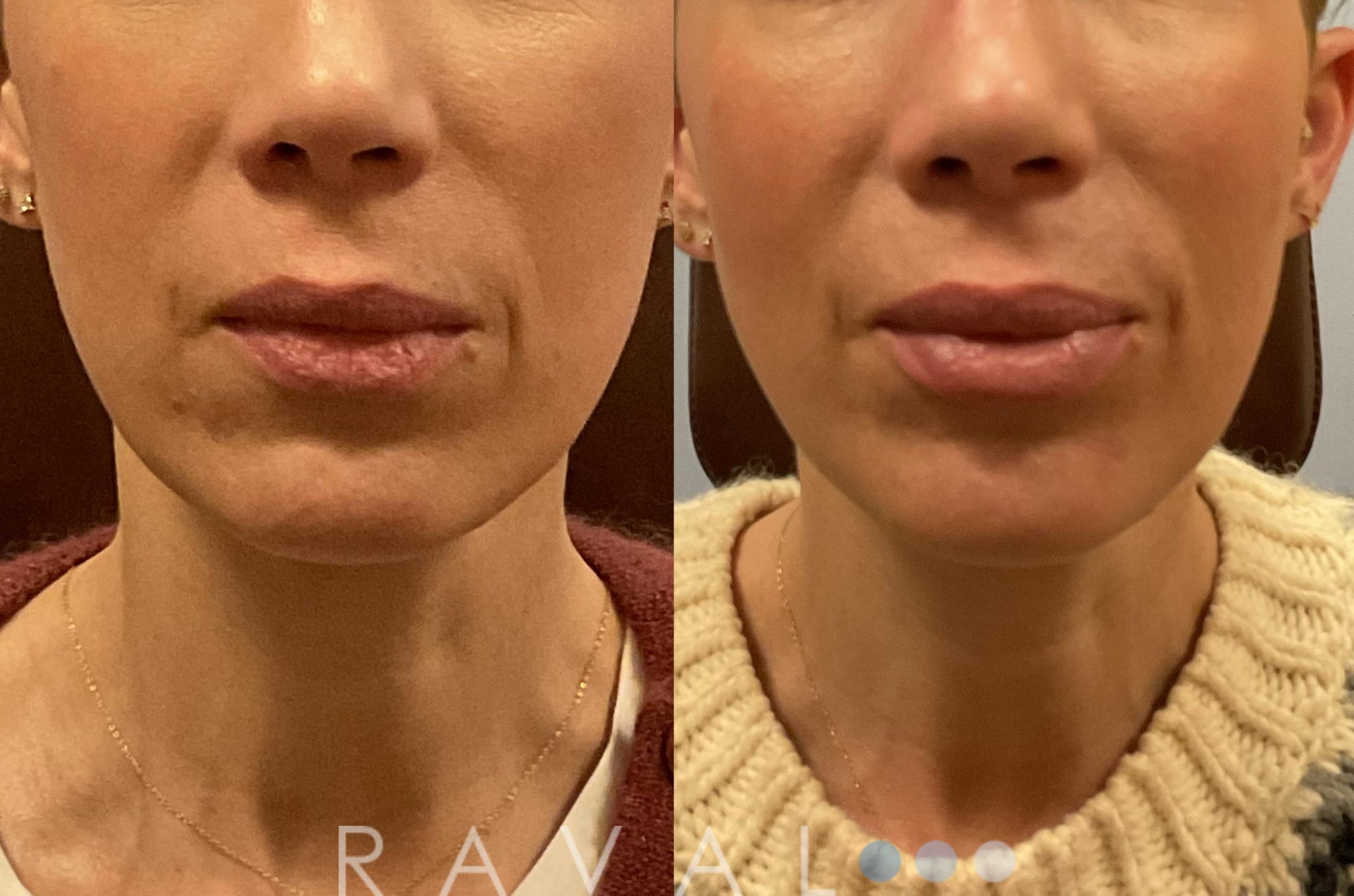 Before & After Botox & Dermal Fillers Case 1137 View 1 View in Denver, CO