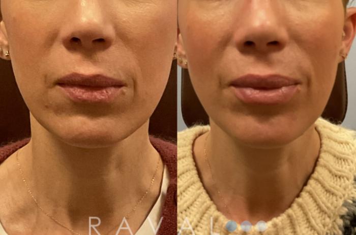 Before & After Botox & Dermal Fillers Case 1137 View 1 View in Denver, CO