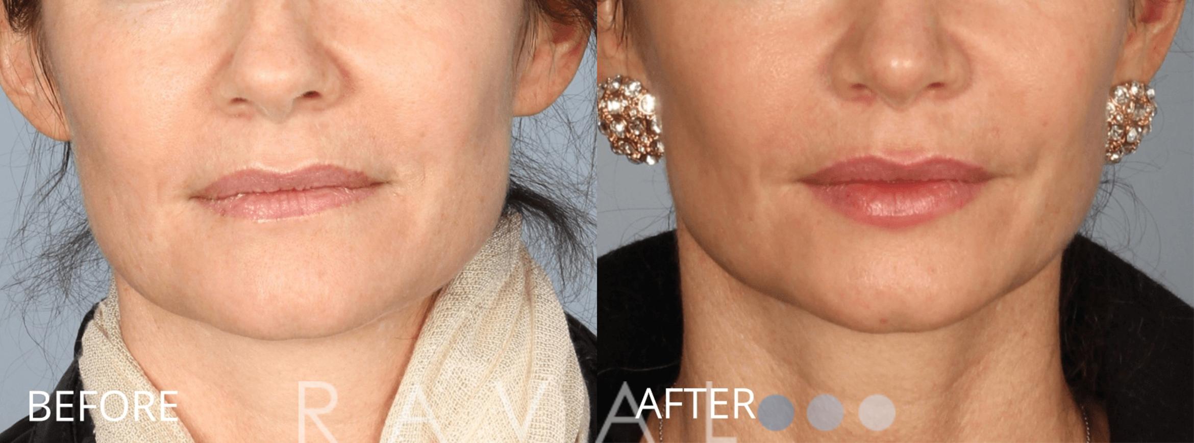 Before & After Botox & Dermal Fillers Case 1138 View 1 View in Denver, CO
