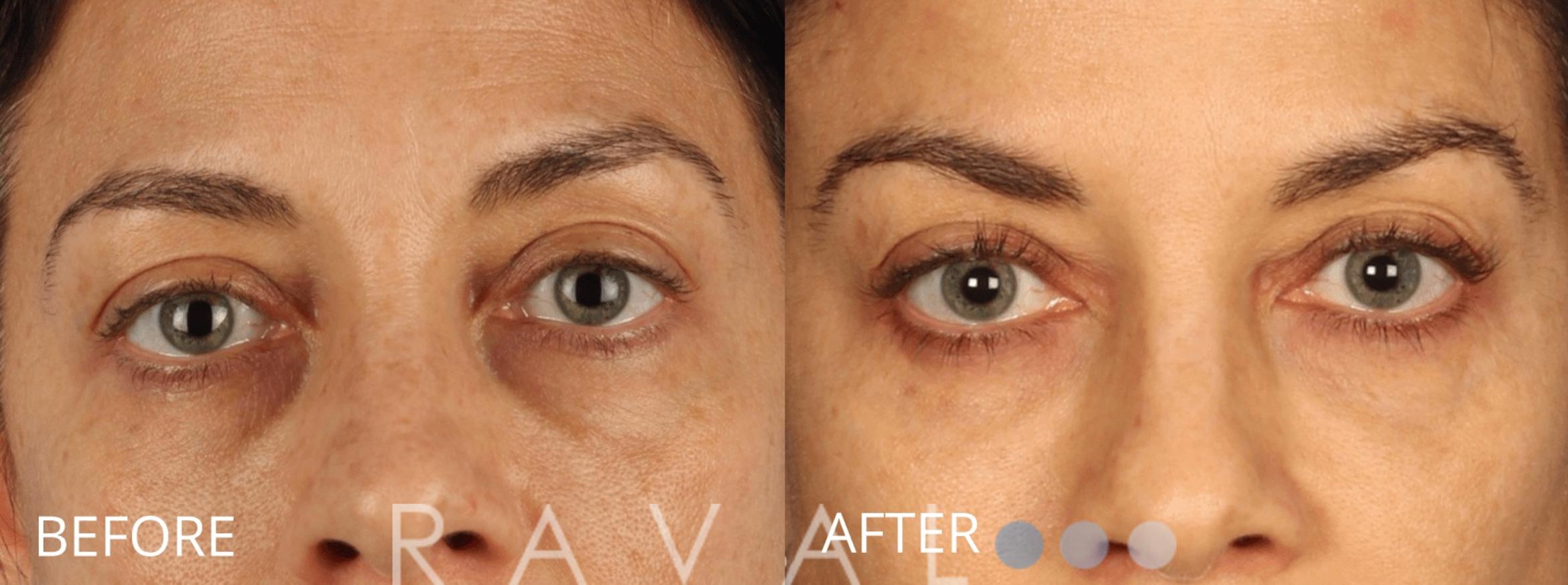 Before & After Botox & Dermal Fillers Case 1140 View 1 View in Denver, CO