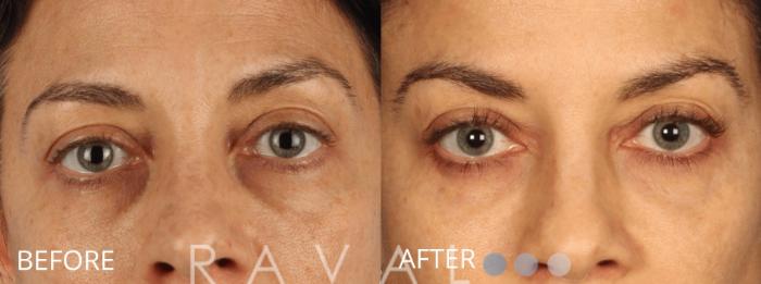 Before & After Botox & Dermal Fillers Case 1140 View 1 View in Denver, CO