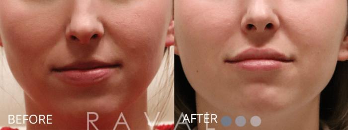 Before & After Botox & Dermal Fillers Case 1141 View 1 View in Denver, CO
