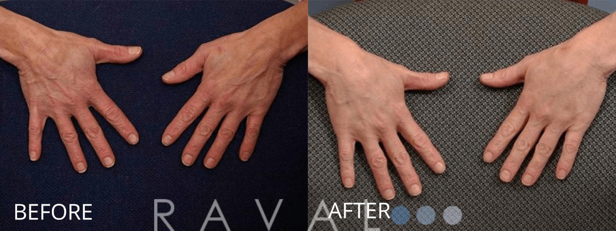 Before & After Botox & Dermal Fillers Case 1142 View 1 View in Denver, CO