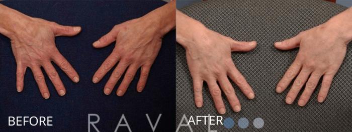 Before & After Botox & Dermal Fillers Case 1142 View 1 View in Denver, CO