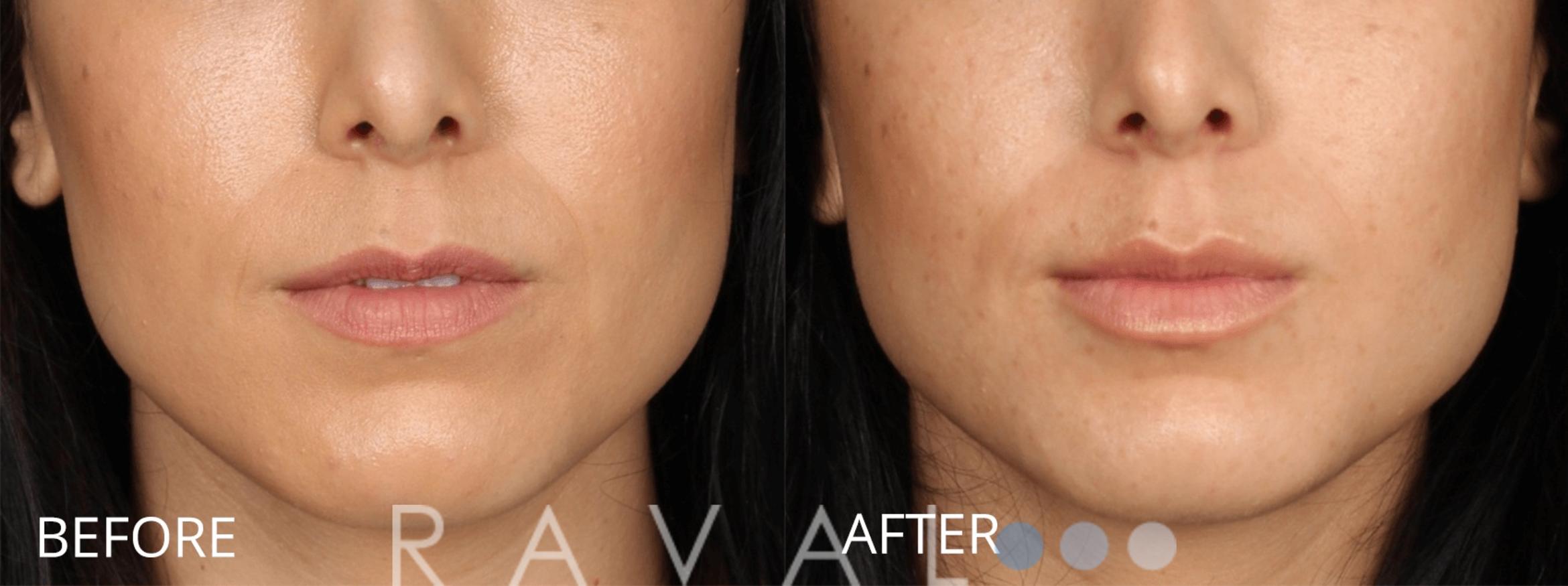 Before & After Botox & Dermal Fillers Case 1143 View 1 View in Denver, CO
