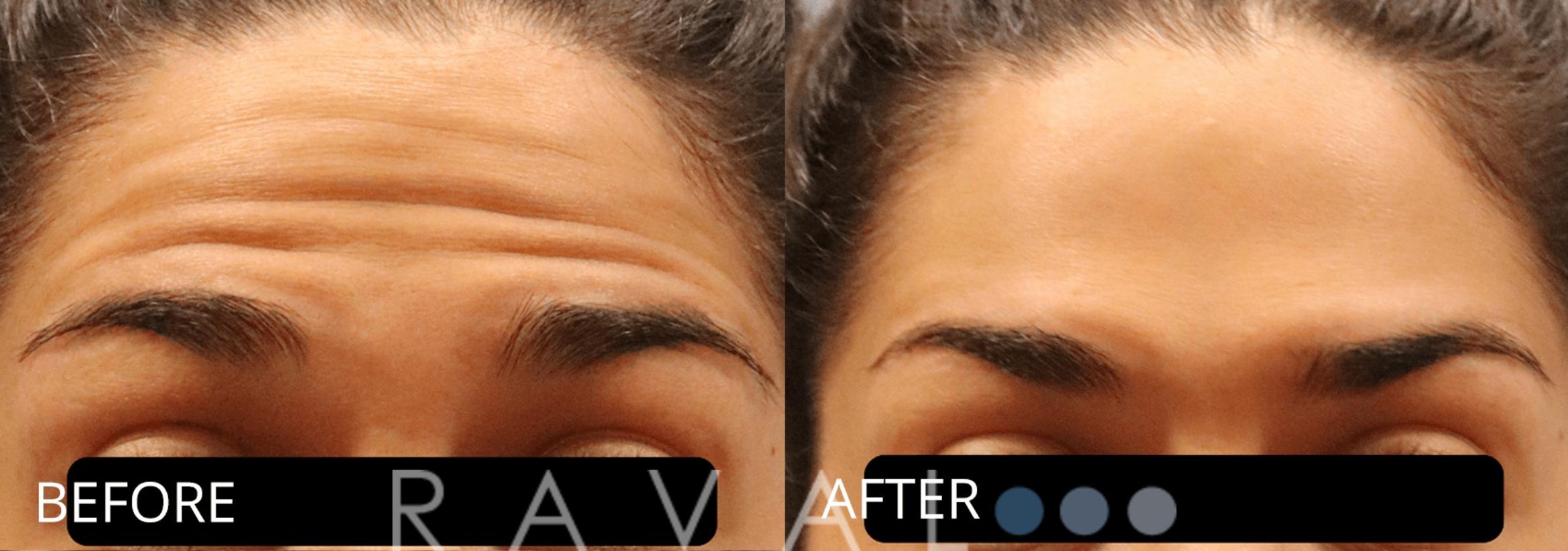 Before & After Botox & Dermal Fillers Case 1144 View 1 View in Denver, CO
