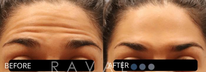 Before & After Botox & Dermal Fillers Case 1144 View 1 View in Denver, CO