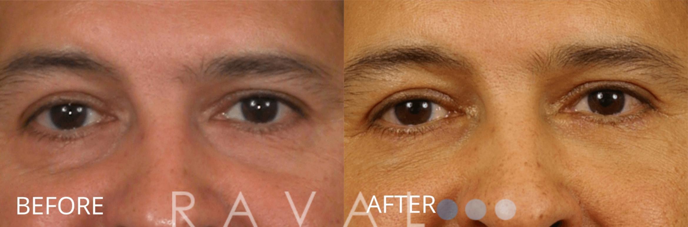 Before & After Botox & Dermal Fillers Case 1145 View 1 View in Denver, CO