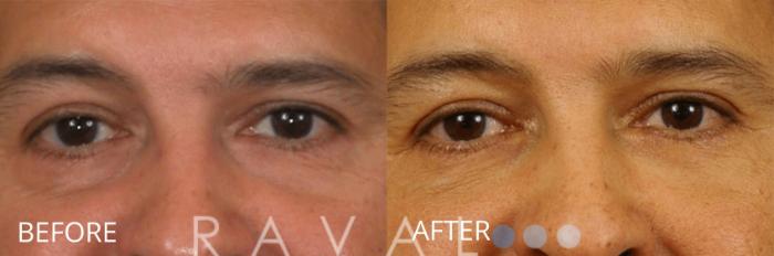 Before & After Botox & Dermal Fillers Case 1145 View 1 View in Denver, CO