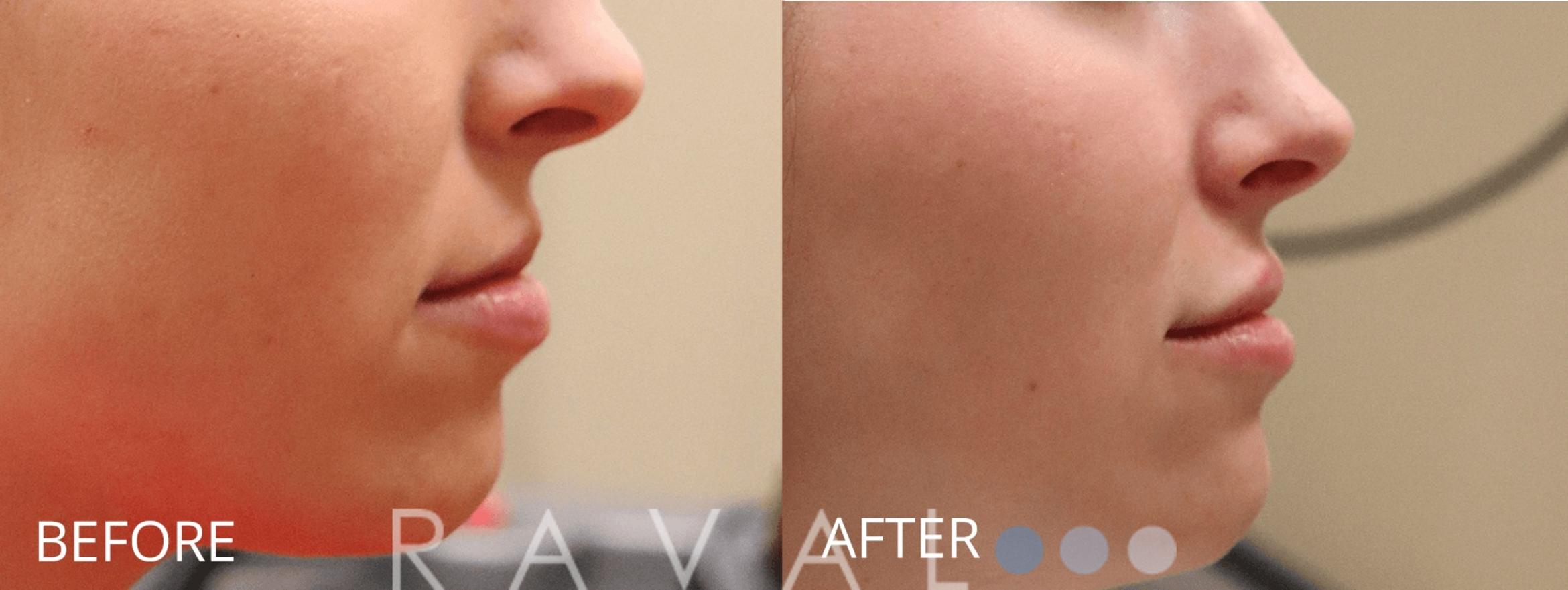 Before & After Botox & Dermal Fillers Case 1146 View 1 View in Denver, CO