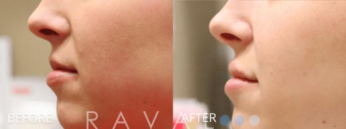 Before & After Botox & Dermal Fillers Case 1146 View 2 View in Denver, CO