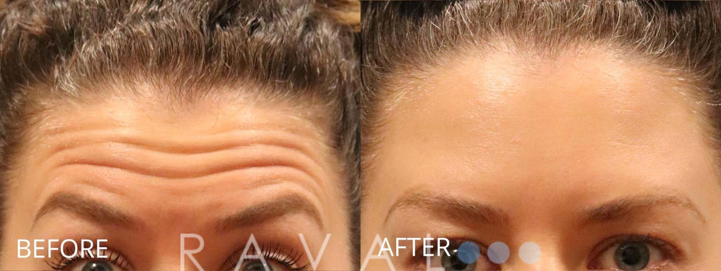 Before & After Botox & Dermal Fillers Case 1147 View 1 View in Denver, CO