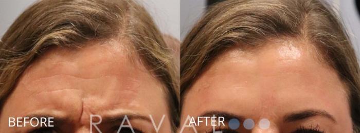 Before & After Botox & Dermal Fillers Case 1148 View 1 View in Denver, CO