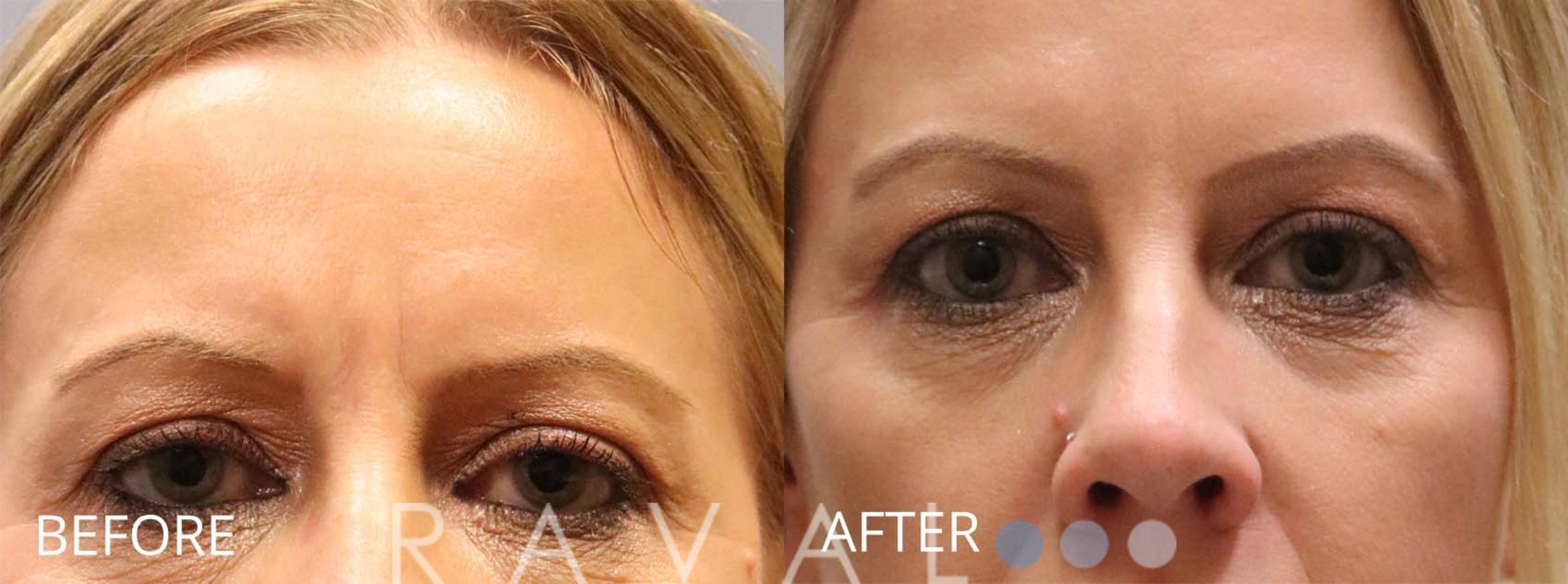 Before & After Botox & Dermal Fillers Case 1149 View 1 View in Denver, CO