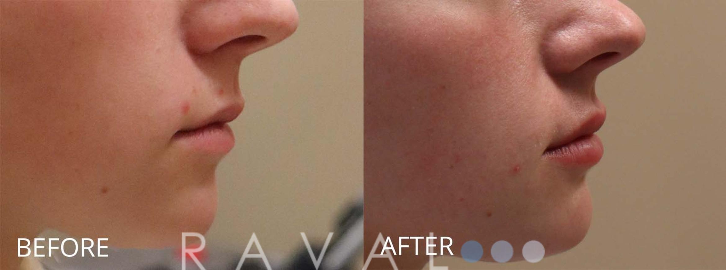 Before & After Botox & Dermal Fillers Case 1150 View 1 View in Denver, CO
