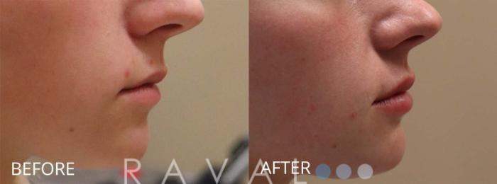 Before & After Botox & Dermal Fillers Case 1150 View 1 View in Denver, CO