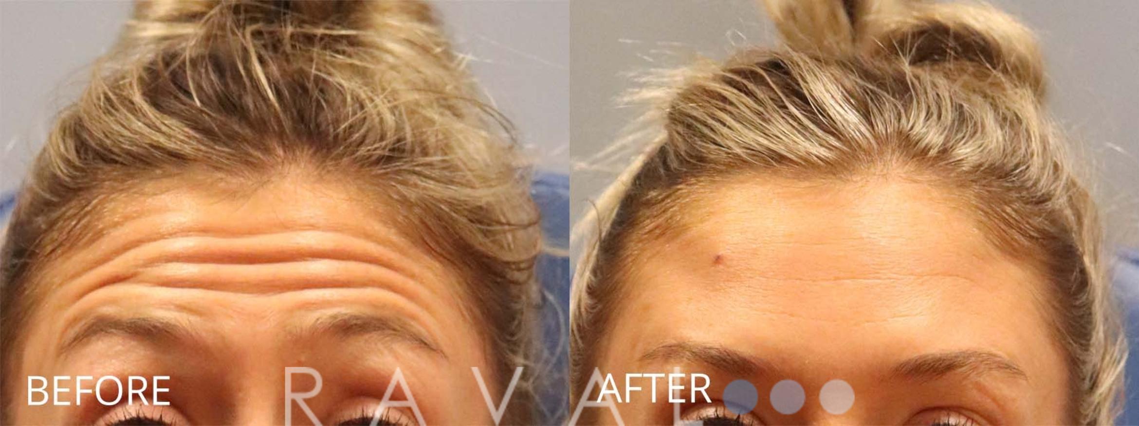 Before & After Botox & Dermal Fillers Case 1151 View 1 View in Denver, CO