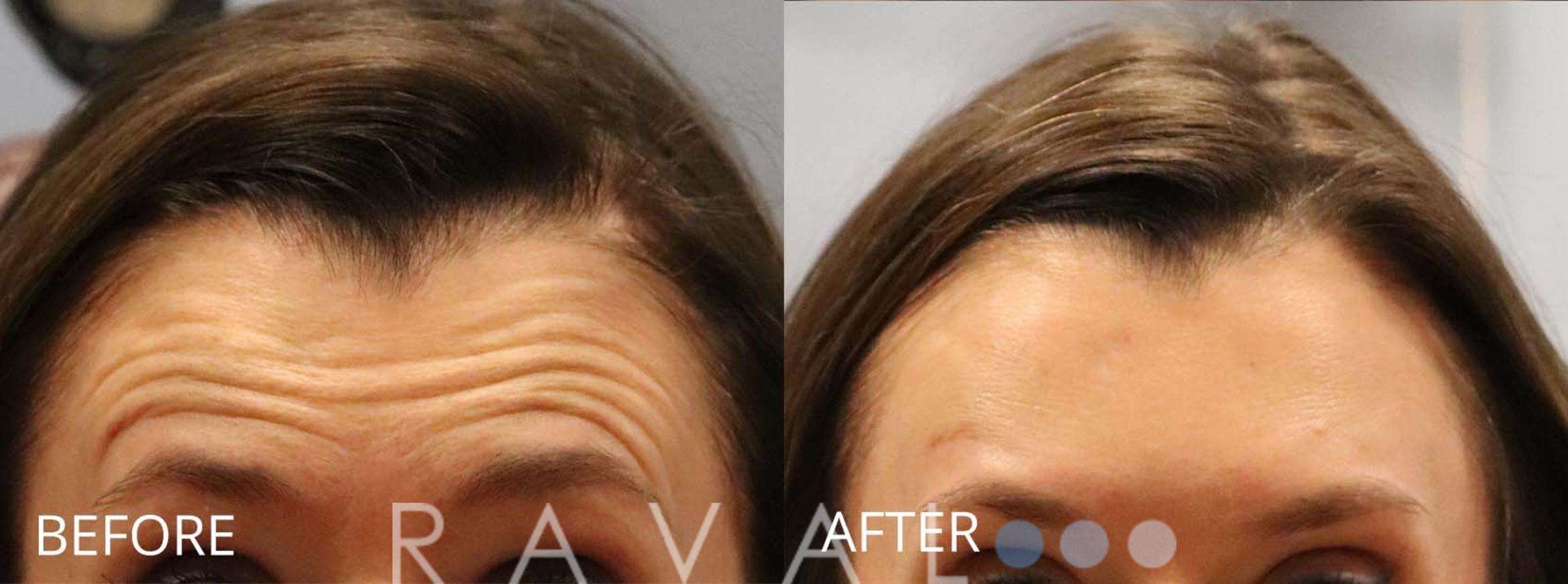 Before & After Botox & Dermal Fillers Case 1152 View 1 View in Denver, CO