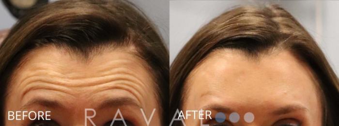 Before & After Botox & Dermal Fillers Case 1152 View 1 View in Denver, CO