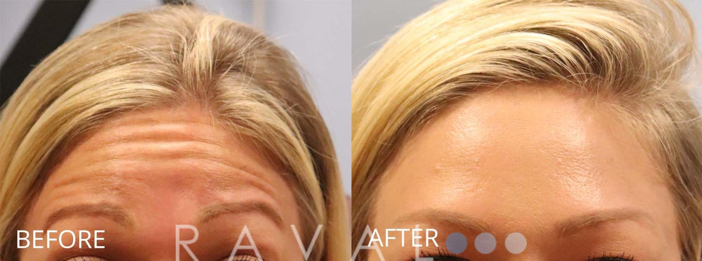 Before & After Botox & Dermal Fillers Case 1153 View 1 View in Denver, CO