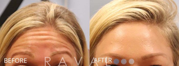 Before & After Botox & Dermal Fillers Case 1153 View 1 View in Denver, CO