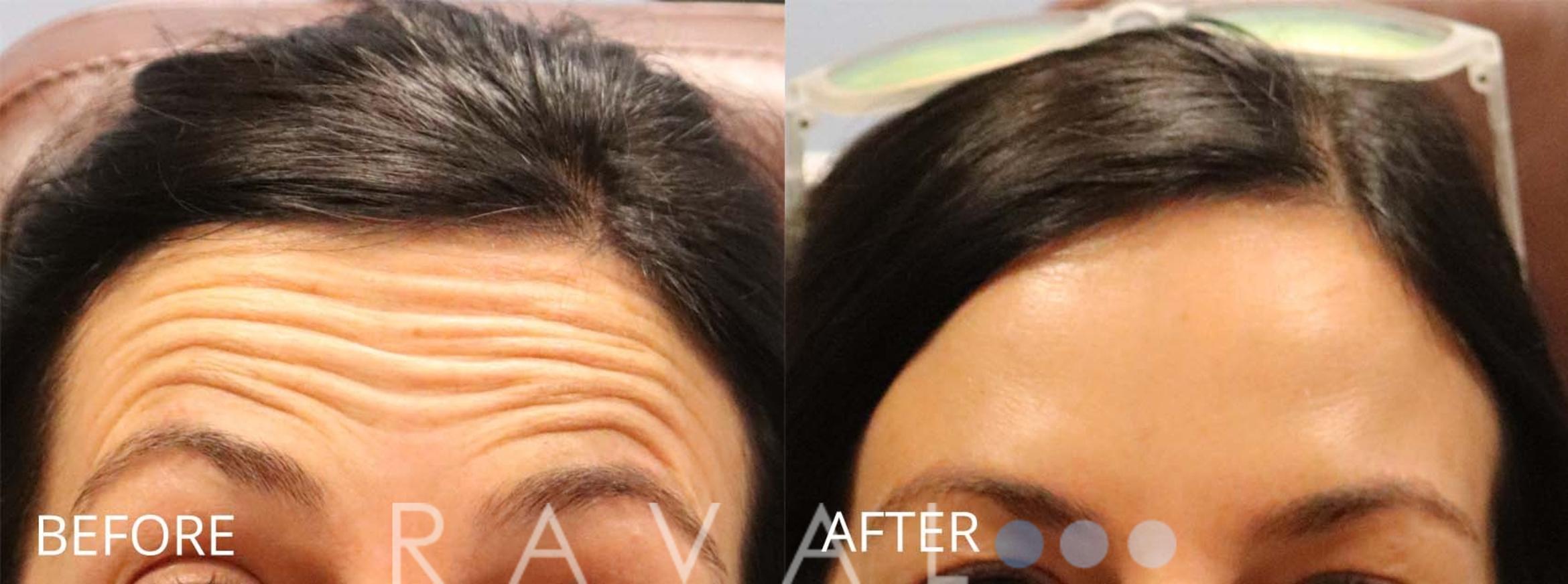 Before & After Botox & Dermal Fillers Case 1154 View 1 View in Denver, CO