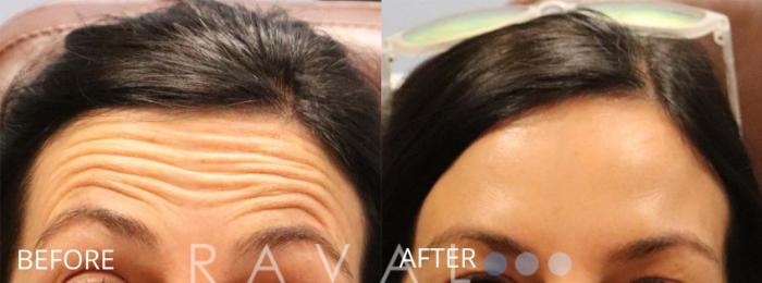 Before & After Botox & Dermal Fillers Case 1154 View 1 View in Denver, CO