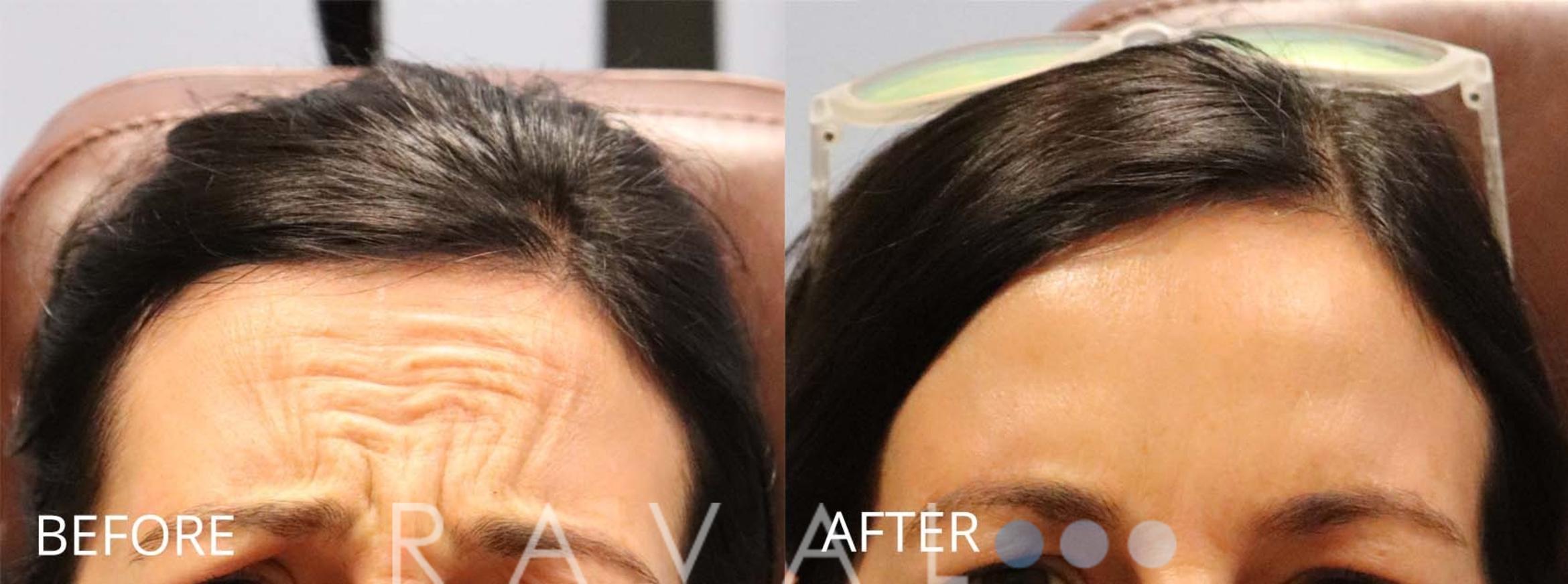 Before & After Botox & Dermal Fillers Case 1155 View 1 View in Denver, CO