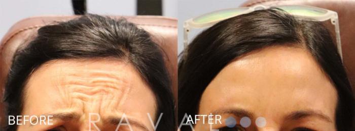 Before & After Botox & Dermal Fillers Case 1155 View 1 View in Denver, CO