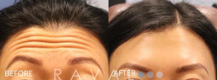 Before & After Botox & Dermal Fillers Case 1156 View 1 View in Denver, CO