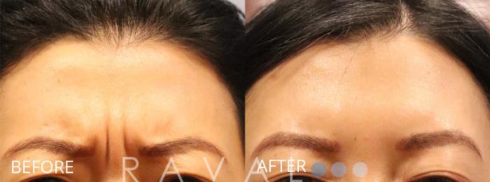 Before & After Botox & Dermal Fillers Case 1157 View 1 View in Denver, CO