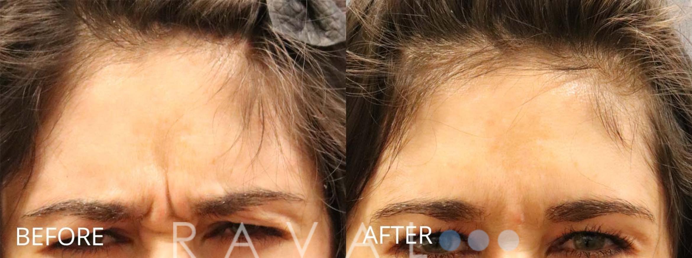 Before & After Botox & Dermal Fillers Case 1158 View 1 View in Denver, CO