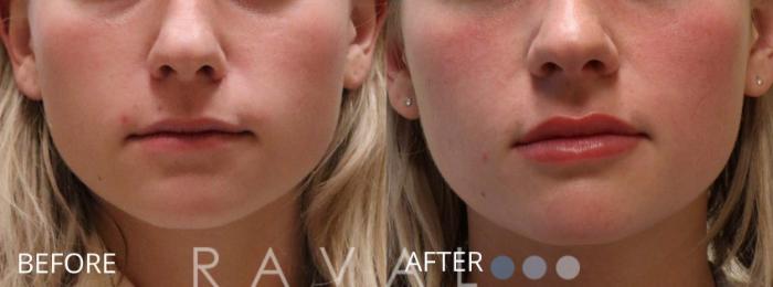 Before & After Botox & Dermal Fillers Case 1159 View 1 View in Denver, CO