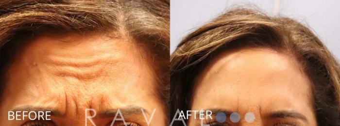 Before & After Botox & Dermal Fillers Case 1160 View 1 View in Denver, CO
