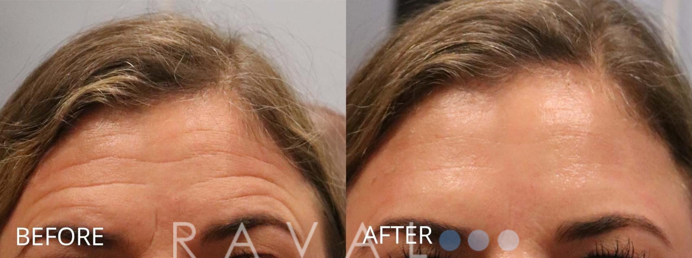 Before & After Botox & Dermal Fillers Case 1161 View 1 View in Denver, CO